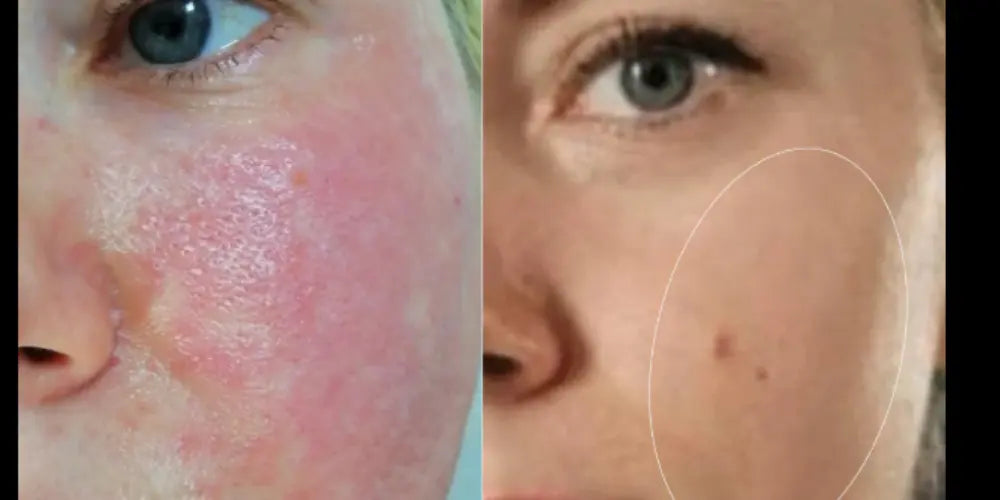 Why Does My Derma Roller Cause Redness?